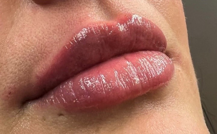 fillers-1